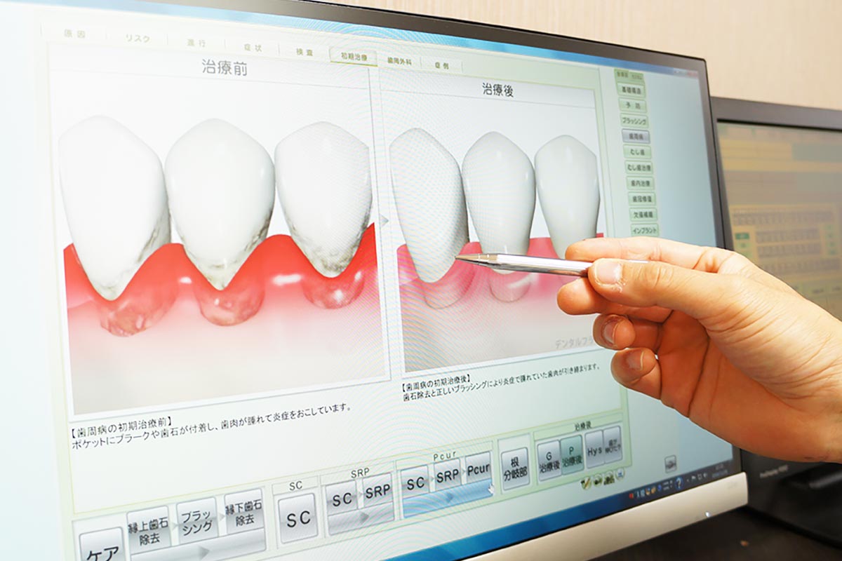 虫歯治療について詳しくご説明