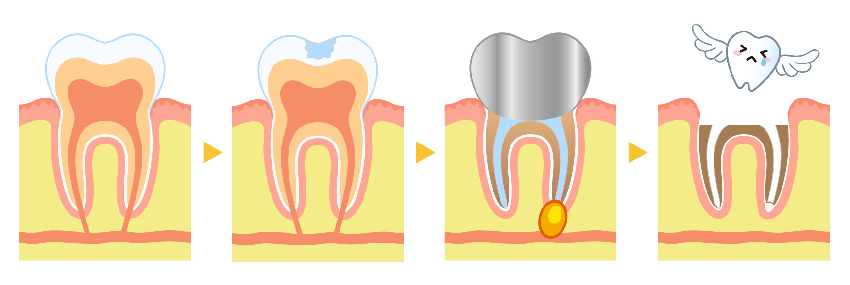 虫歯で歯を失うサイクル