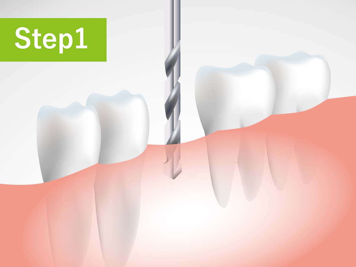 成田歯科・矯正歯科医院の虫歯治療