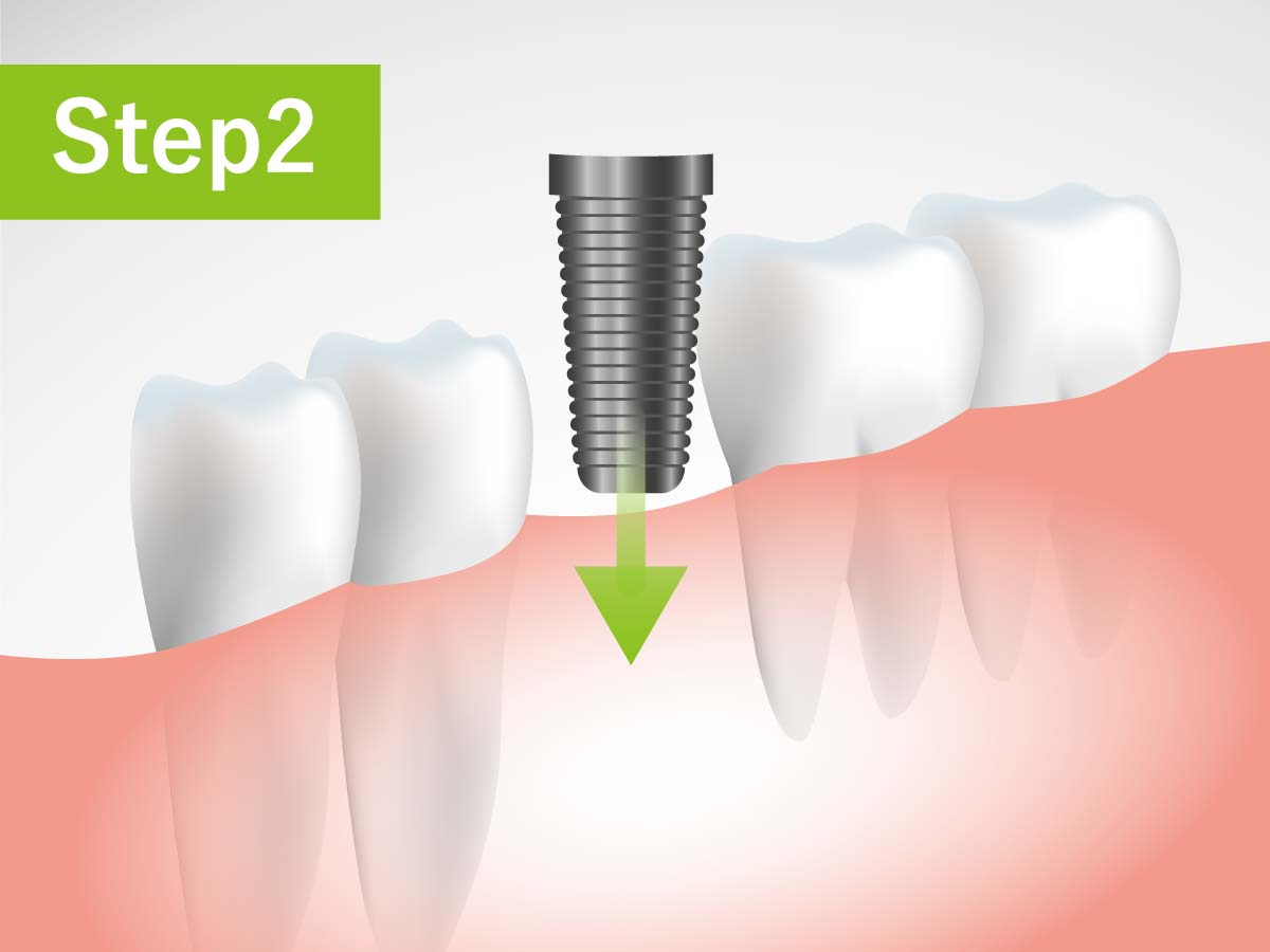 成田歯科・矯正歯科医院の虫歯治療