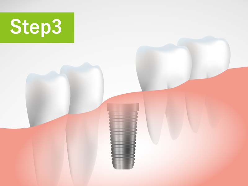 成田歯科・矯正歯科医院の虫歯治療