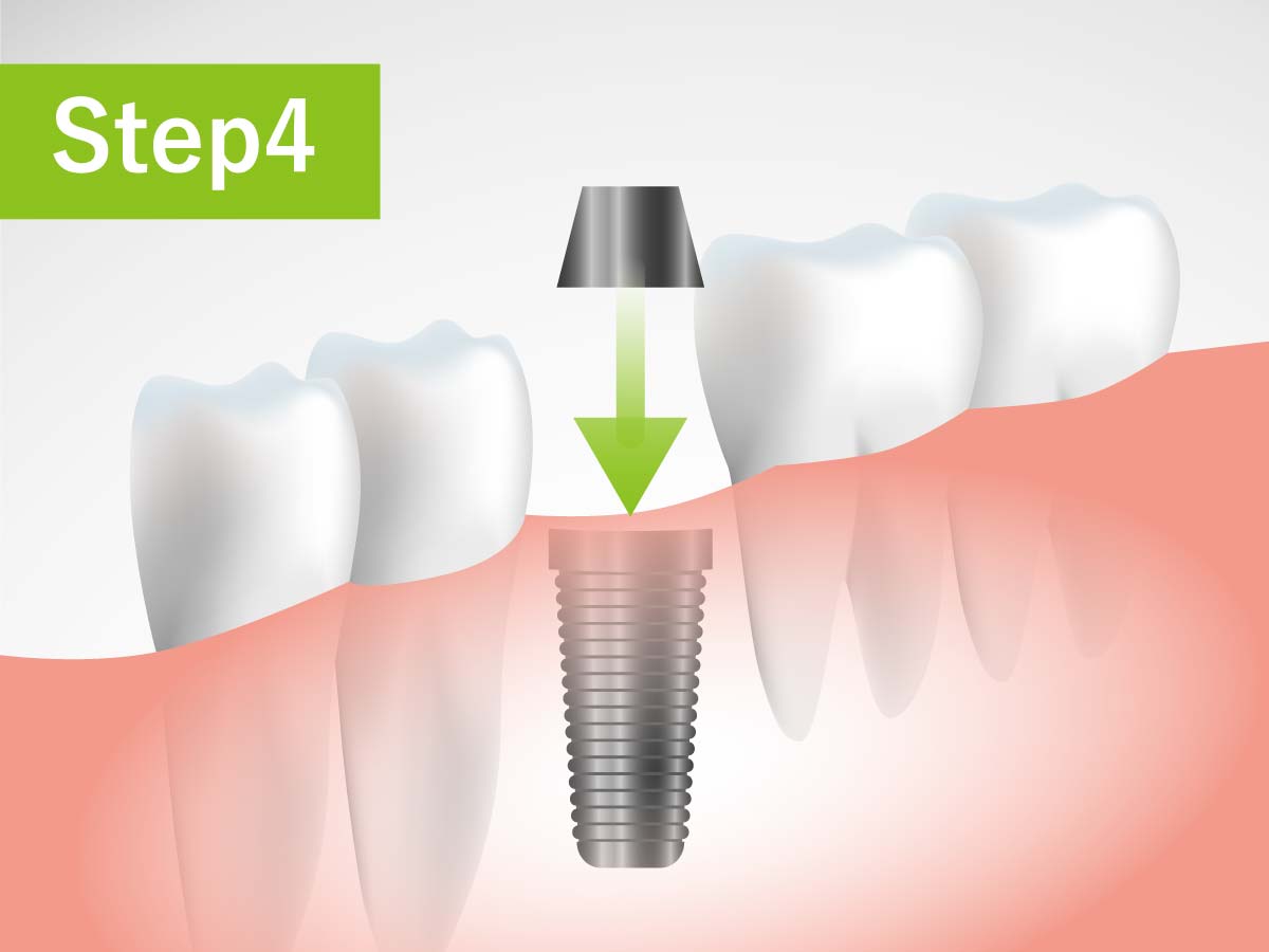 成田歯科・矯正歯科医院の虫歯治療