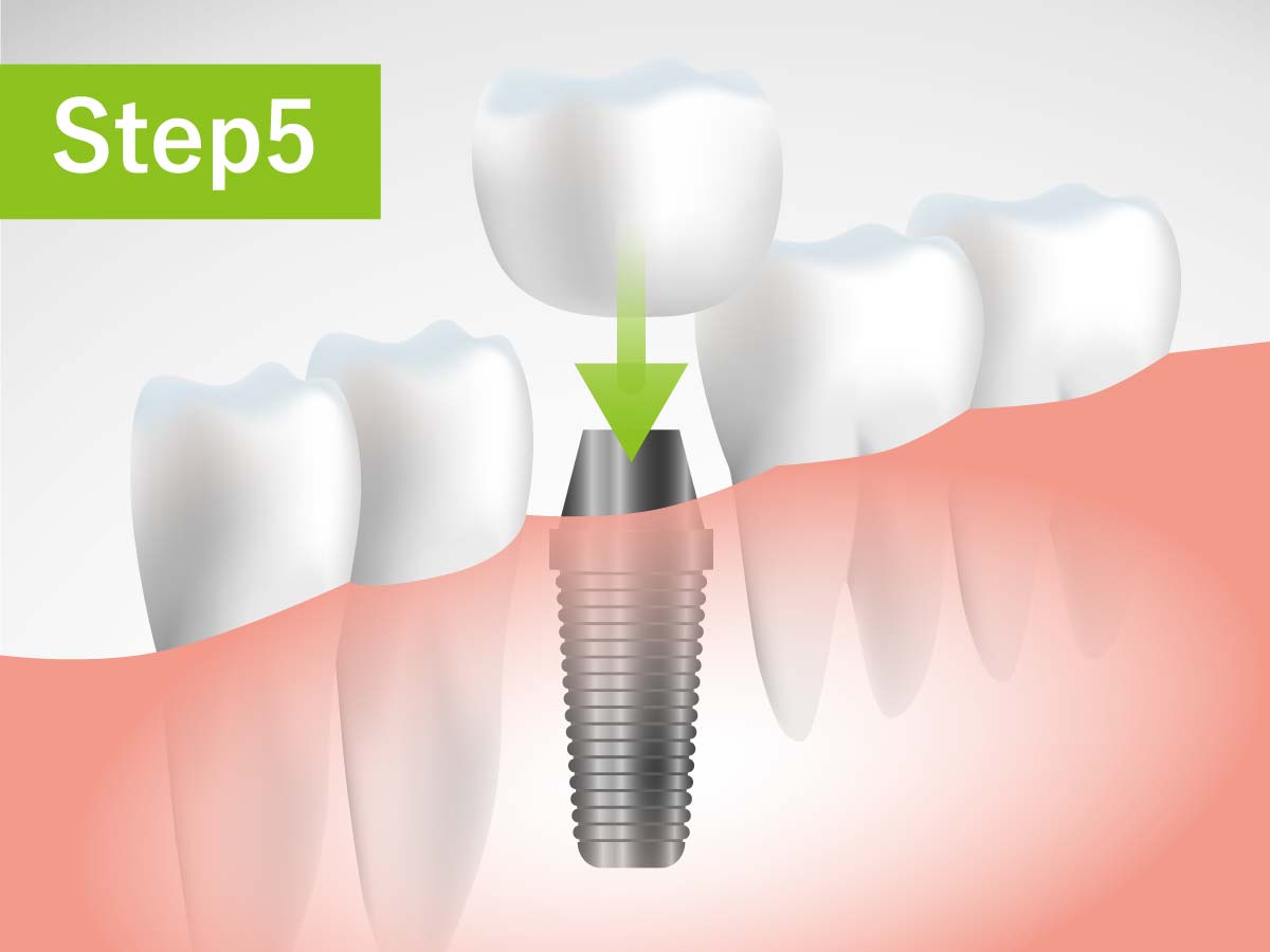 成田歯科・矯正歯科医院の虫歯治療