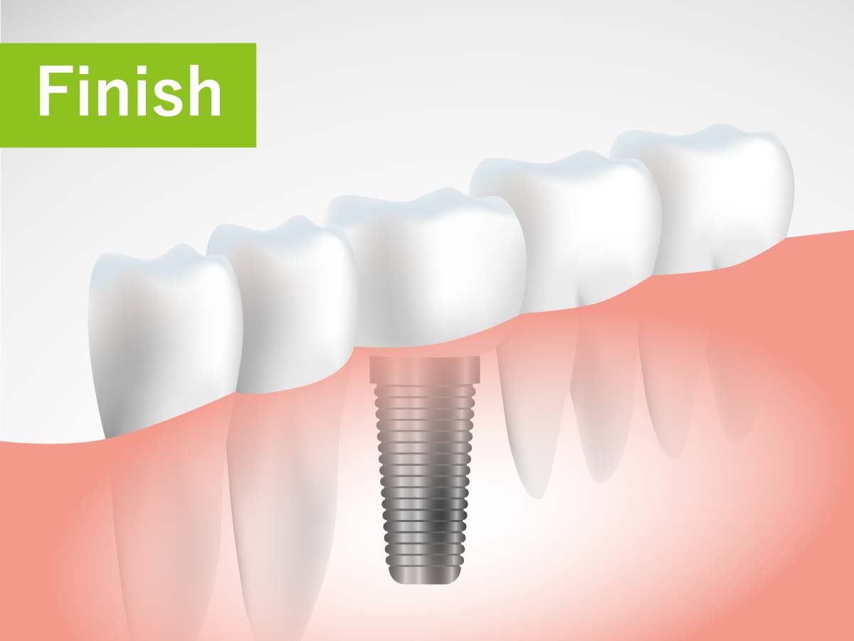 成田歯科・矯正歯科医院の虫歯治療