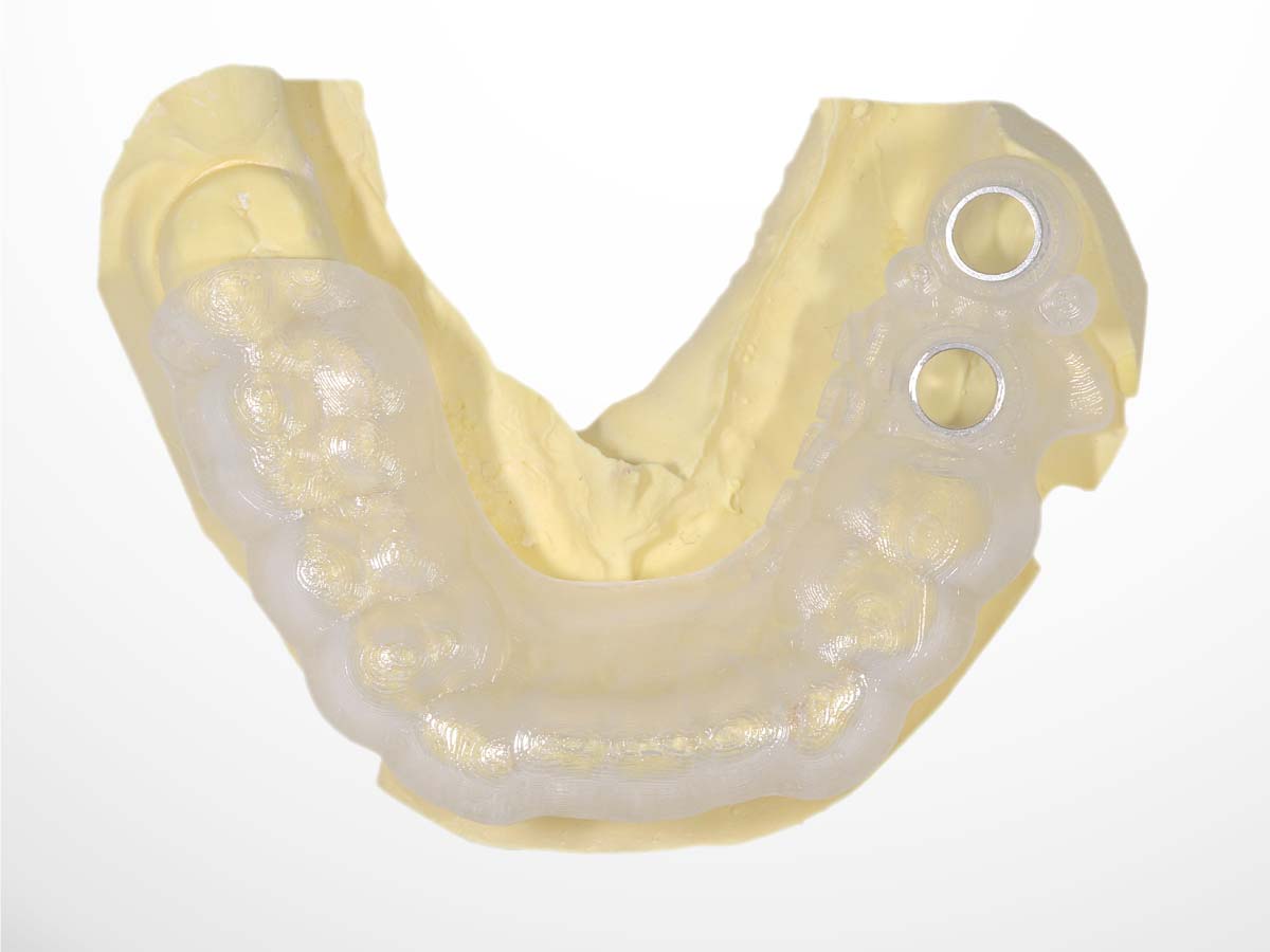 サージカルガイド