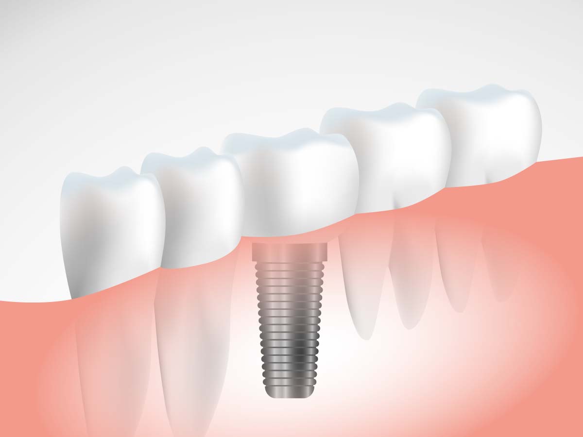 インプラント治療