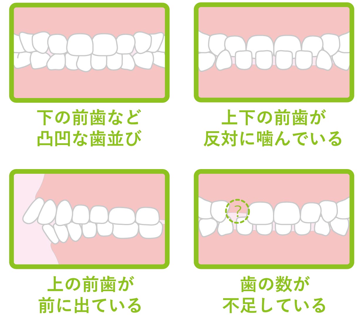 早期管理したい子どもの歯並び