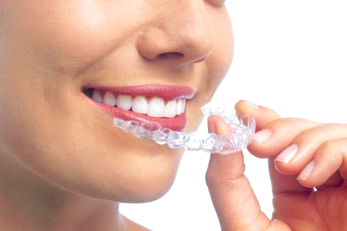 マウスピース矯正